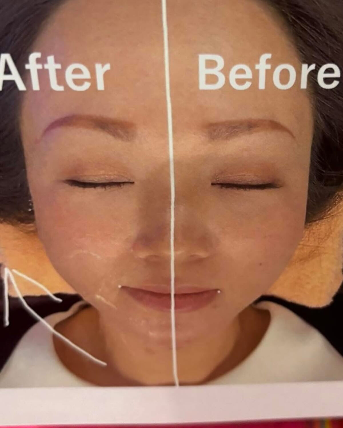 Face lift 